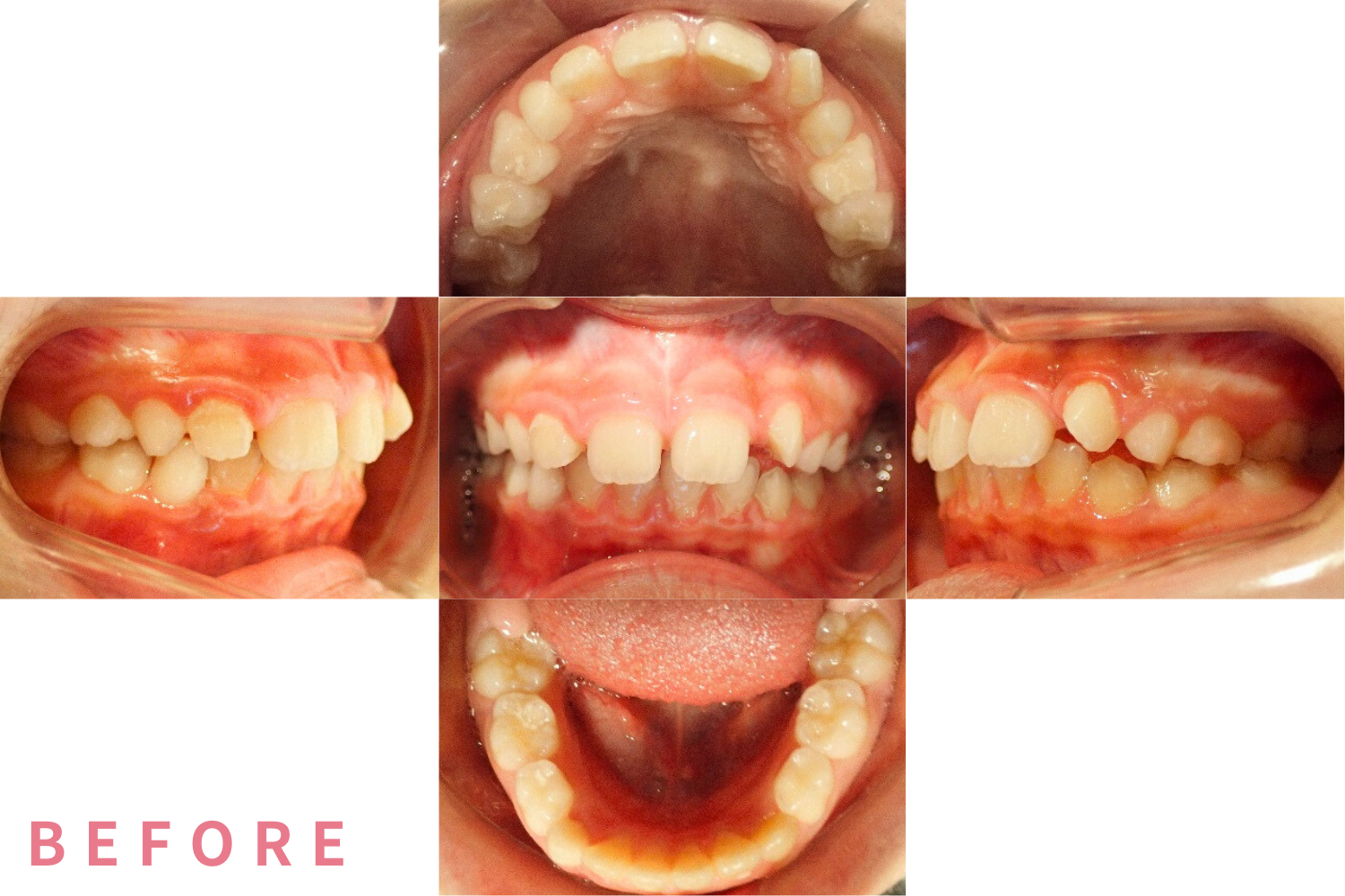 バイオネーター（機能的矯正装置）症例01（ビフォー）｜愛育クリニック麻布歯科ユニット