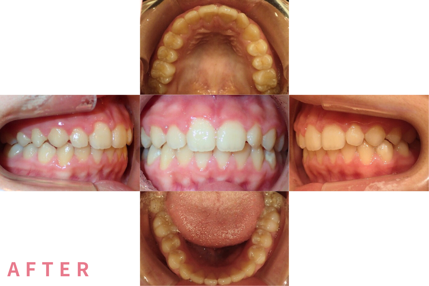 バイオネーター（機能的矯正装置）症例01（アフター）｜愛育クリニック麻布歯科ユニット